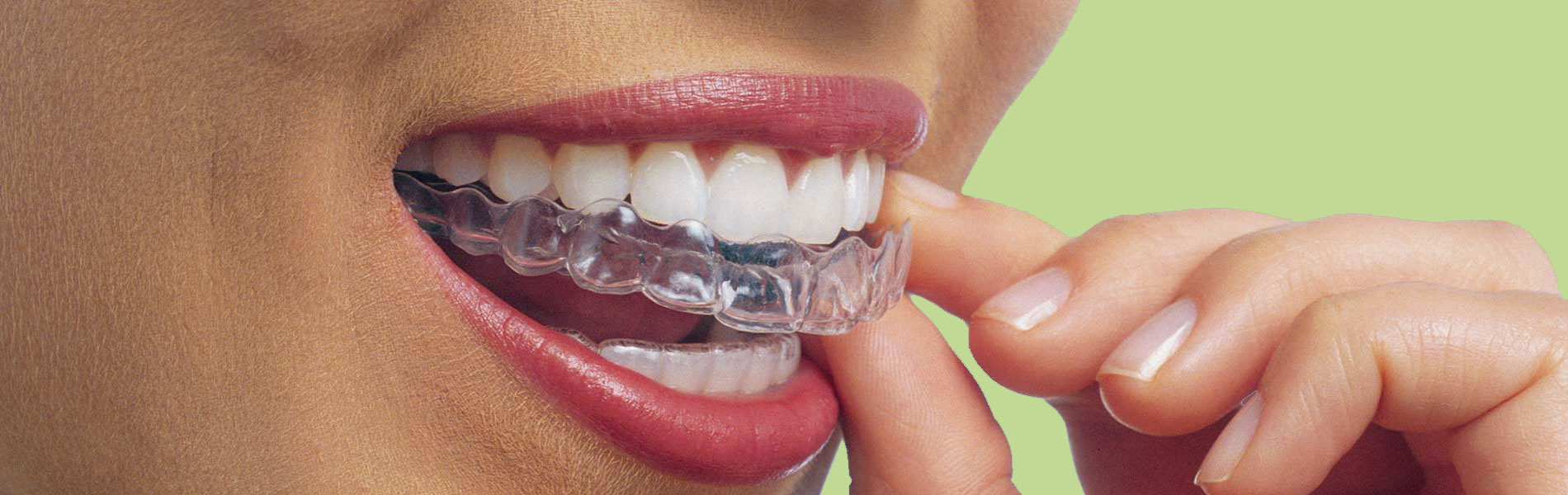 Invisalign - ortodontia