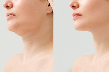Female double chin before and after correction. Correction of the chin shape liposuction of the neck. The result of the procedure in the clinic of aesthetic medicine